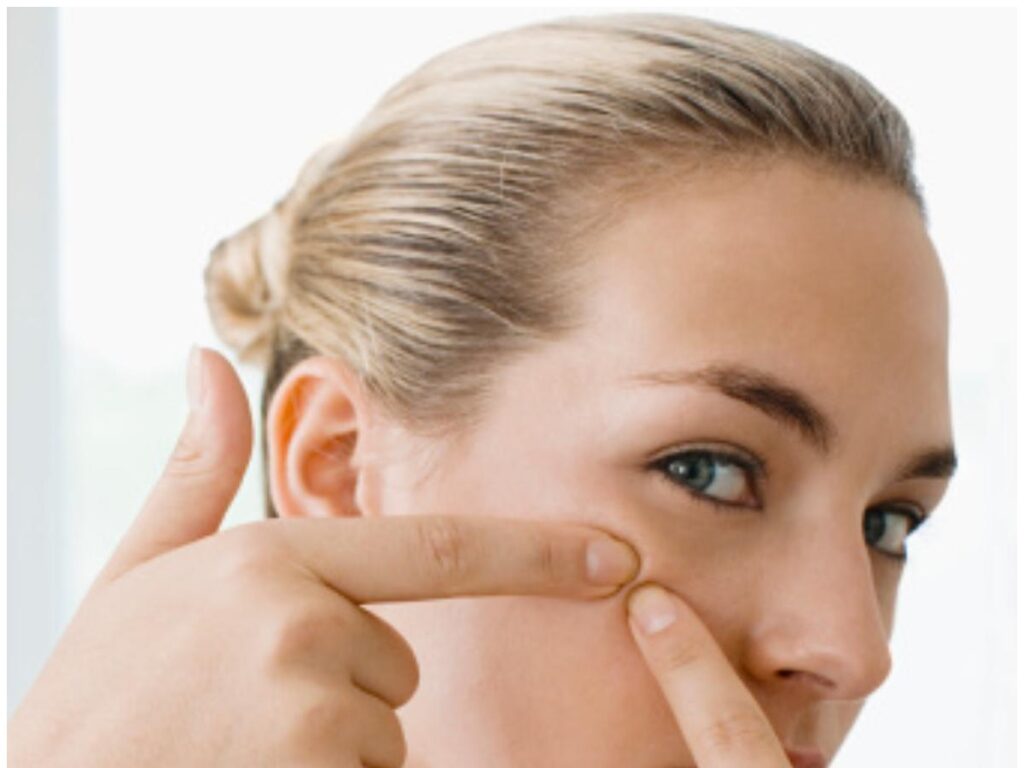 How To Remove Whiteheads At Home